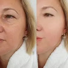 Ellanse en Valencia: bioestimulación, luz y arquitectura dérmica